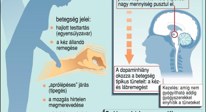 Egyre több fiatal is parkinson-os – Pécsen agyi stimulációval tudnak segíteni akár távolról is