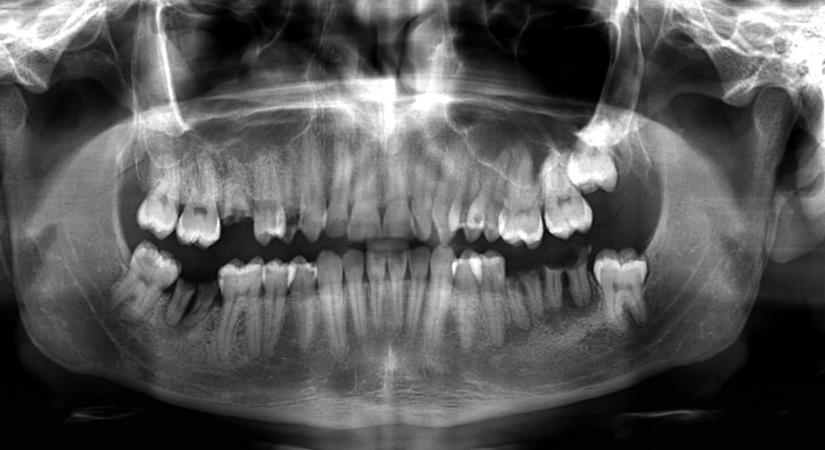 Kevesen tudják, de ha nem megy el fogorvoshoz, komoly baja lehet