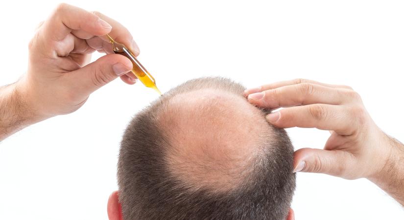 Ezek a legmodernebb kezelések a hajhullás, kopaszodás megállítására