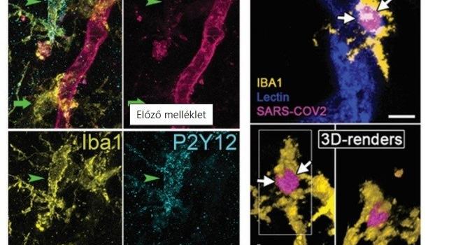 Poszt-covid: a gyulladás szerepe az idegrendszeri zavarok kialakulásában
