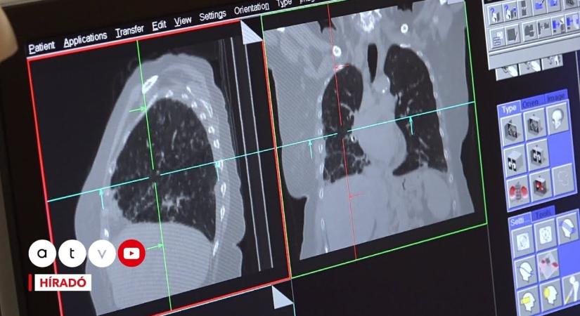 Sokkoló jelentés: meredeken nő a rákos megbetegedések száma a fiatal nők körében