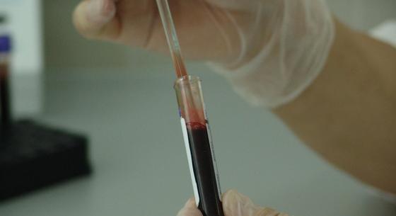 Egy 2400 forintos teszt segíthet megmondani, hogy lehet-e az embernek szívrohama vagy stroke-ja 10 éven belül