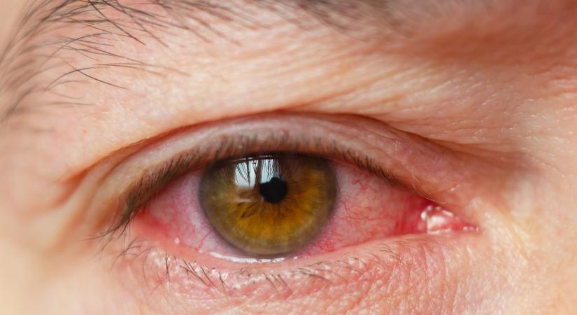 Allergiaszezon: Tünetek, okok és kezelési lehetőségek