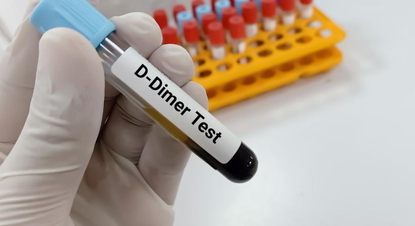 Mit jelent a D-dimer érték a laborleleten?