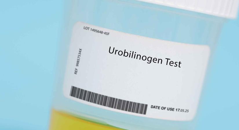 Mit jelent az urobilinogén (UBG) érték a laborleleten?