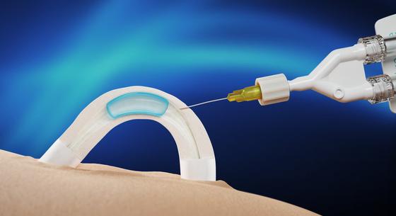 Jöhet a hormonmentes, férfi fogamzásgátló-implantátum, ami két éven át fejti ki hatását