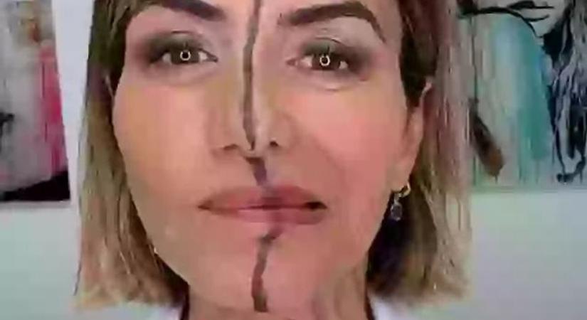 A botox hatása? Döbbenetes, amit az orvos művelt magával