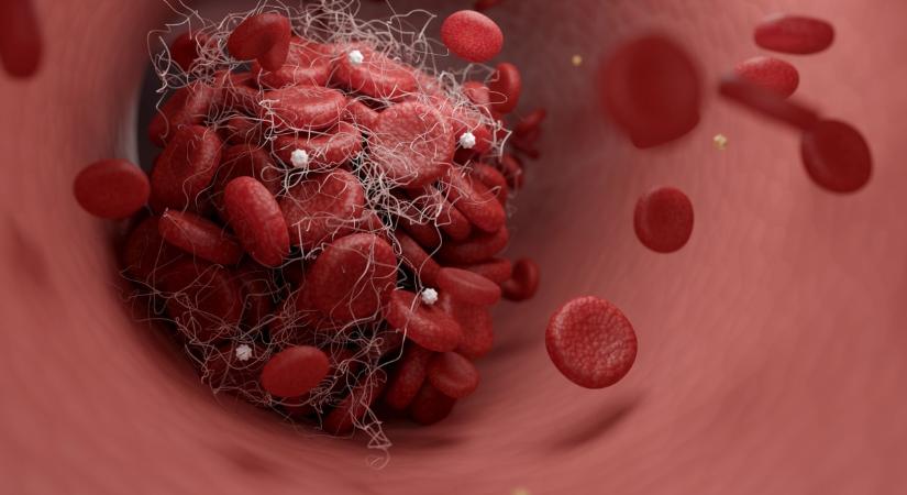 A vérben lévő mikroműanyagok akár el is zárhatják az ereket és stroke-ot okozhatnak