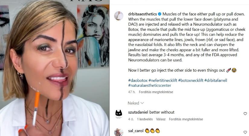 Ezt teszi a botox az arcoddal - ijesztő kísérletet végzett el a doktornő