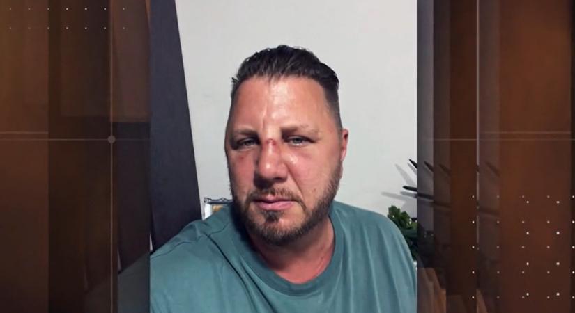 Zámbó Krisztián: Betörték az orrom! – videón az énekes orrtörése
