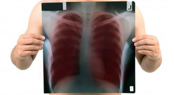 A tuberkulózis (tbc) diagnosztizálása, kezelése és megelőzése