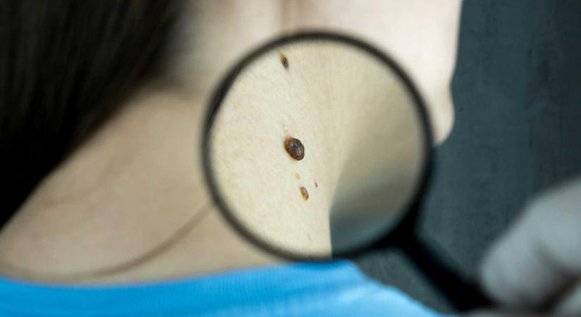 Ingyenes bőrvizsgálat és melanomaszűrés lesz a háromszéki városokban