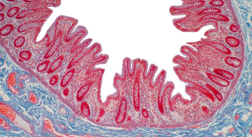 Mikroszkópos colitis: ilyen tünetekkel jár a gyulladásos bélbetegségek (IBD) harmadik típusa