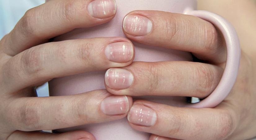 Fehér foltok a körömön: ekkor jelez nagy bajt