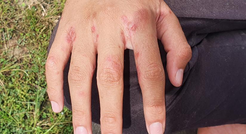 Súlyos betegség bukkant fel a magyar börtönökben: most egy fiatal rabnál fedezték fel