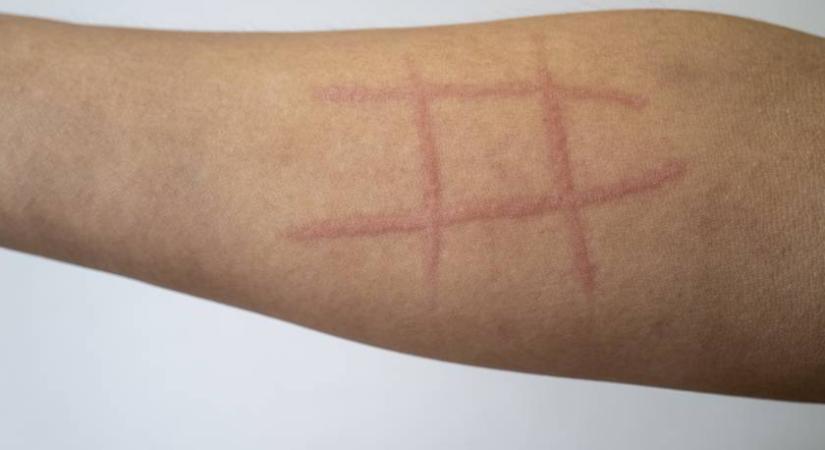 Amikor a körmöddel írni tudsz a bőrödre: ijesztő a dermatográfia, de nem mindig veszélyes