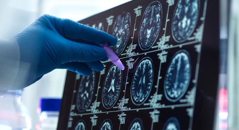 Ezzel a pofonegyszerű módszerrel megelőzhető az Alzheimer-kór