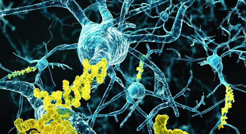 Engedélyezték a vérvizsgálatot Alzheimer-kór diagnosztizálására