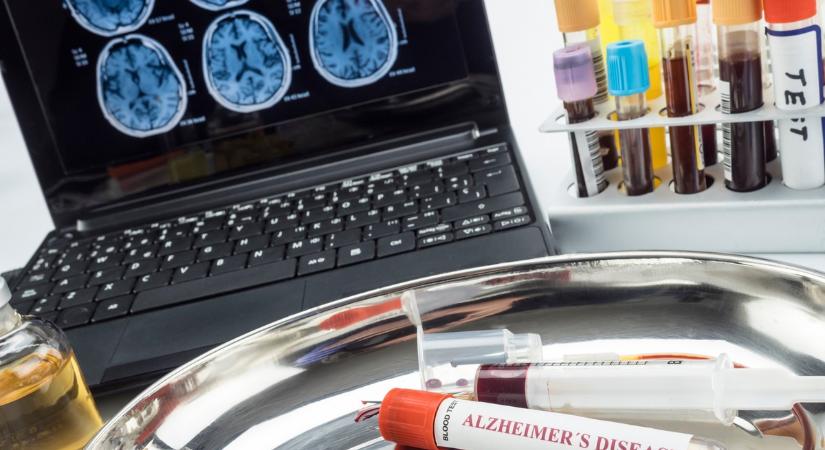 Mérföldkő az Alzheimer-kór diagnózisában – itt az első vérvizsgálati teszt, amit az FDA is jóváhagyott