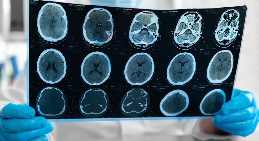 Mennyi idő alatt szívódik fel az agyi ödéma? Erre a három fázisra számítson