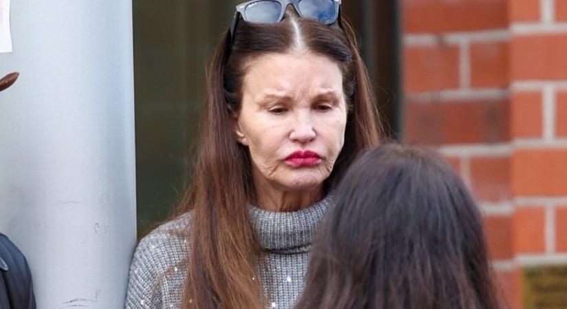 Megrázó képek: íme 6 sztár, akit legyőzött a botox - Fotók