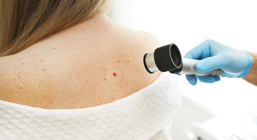 Évente 2500 magyarnál diagnosztizálnak melanomát - ez a szűrés életet menthet