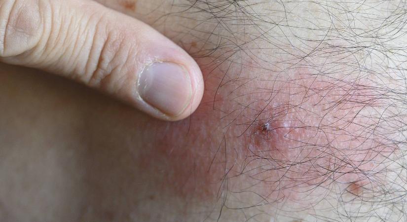 Így ismerheti fel, ha Lyme-kóros