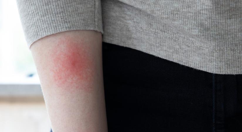Évekkel később is gondot okozhat a kullancscsípés – ezek a Lyme-kór késői tünetei