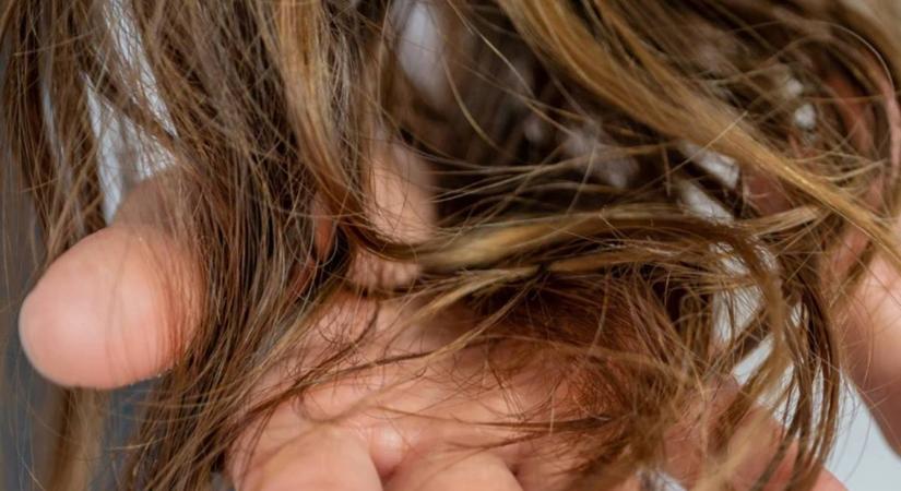 Vékonyodó hajszálakat és törékeny körmöket okozhat egy vitamin hiánya