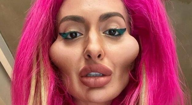 Rémmé műtette magát az Instagram sztár – Így nézett ki a plasztikai beavatkozások előtt