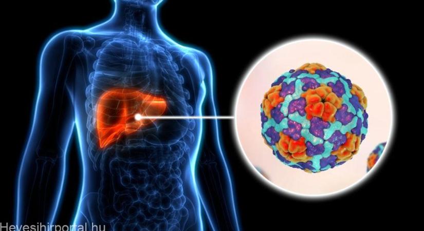 Hepatitis A vírusfertőzés Hevesen