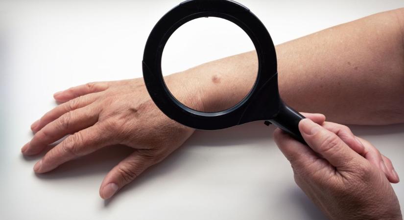 Ne vigyük túlzásba a napon tartózkodást! A melanoma kialakulására figyelmeztet az NNGYK