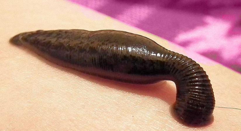 Amputálni kellett egy nő lábát, miután a vecsési természetgyógyásztól piócás kezelést kapott