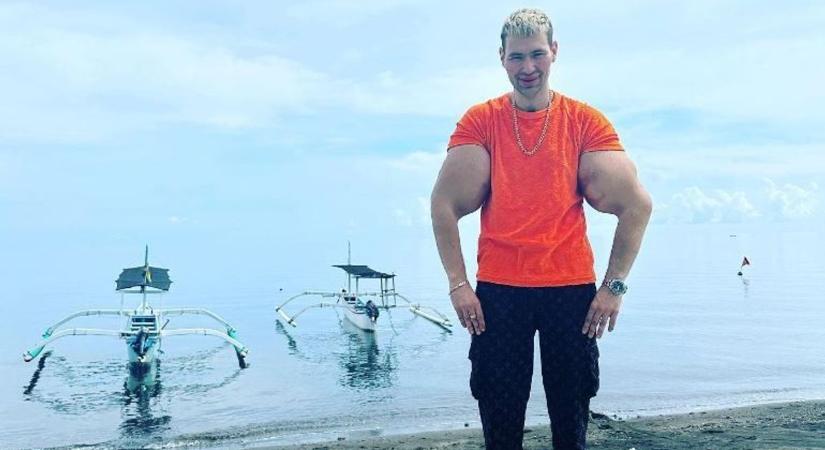 Mű karizmokat csináltatott magának, így néz ki a világ egyik legnagyobb bicepsze