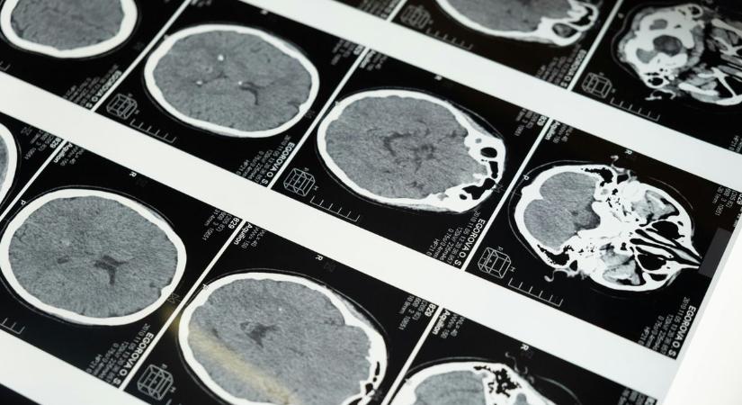 A Harvard kutatói elárulják: így csökkentsd az Alzheimer-kór kialakulásának kockázatát
