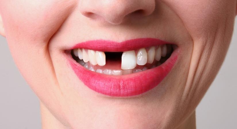 A fogpótlás csapdája: megfizethetetlen luxussá vált a szép mosoly?