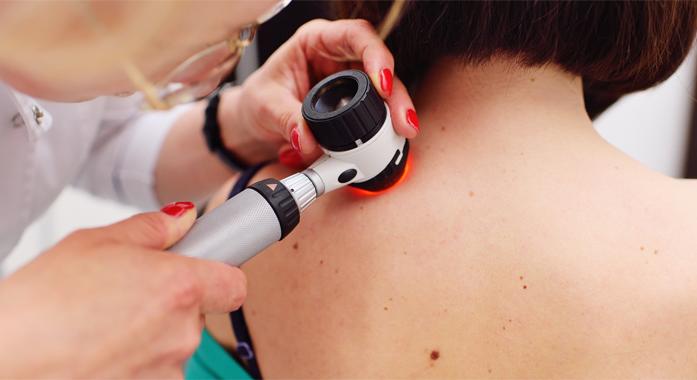 Melanomagyanús anyajegy kimetszése lépésről lépésre