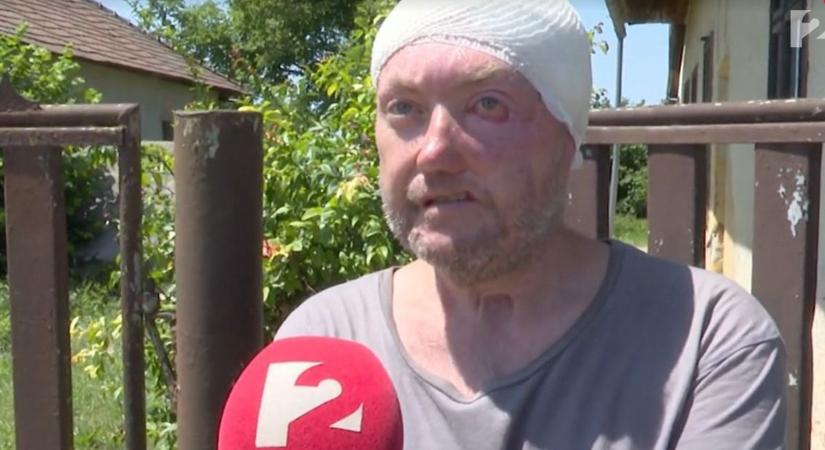 Megszólalt a borsodi férfi, akit majdnem halálra marcangoltak a kutyák – brutálisak a sérülései