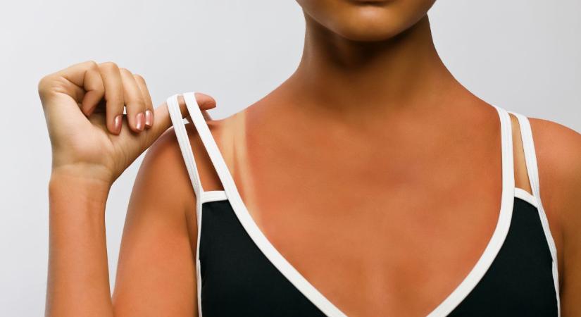Bőrgyógyász: tényleg ennyivel biztonságosabb a barnító spray, mint a napozás? - Marie Claire