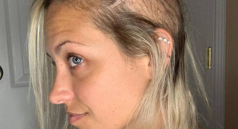 Ez a 26 éves nő 14 évig küzdött hajhullással, végül kopaszra borotválta magát