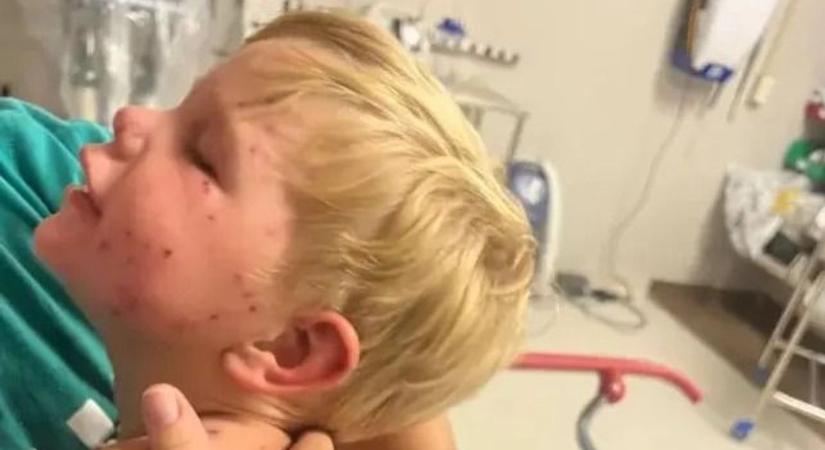 Élet-halál harcot vív a kétéves kisfiú, miután 150 darázs összecsípte