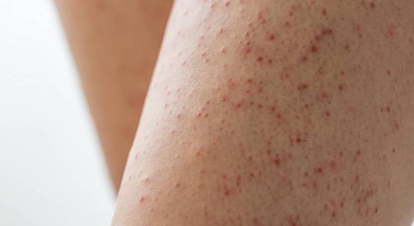 Tilos nyomkodni, ha ilyen dudort látsz a bőrödön: innen ismerhető fel a keratosis pilaris