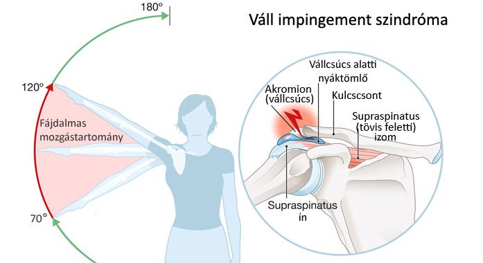 Impingement szindróma (váll ütközési szindróma)