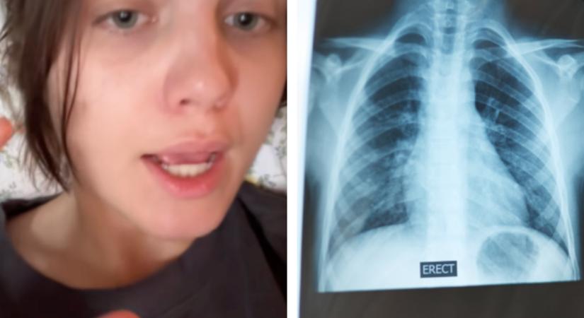Elmesélte a TikTokon, hogy megette a saját bordáját a műtétje után