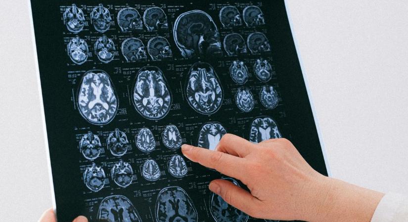 Az agy nem érez fájdalmat – mégis itt születik a fájdalomérzet