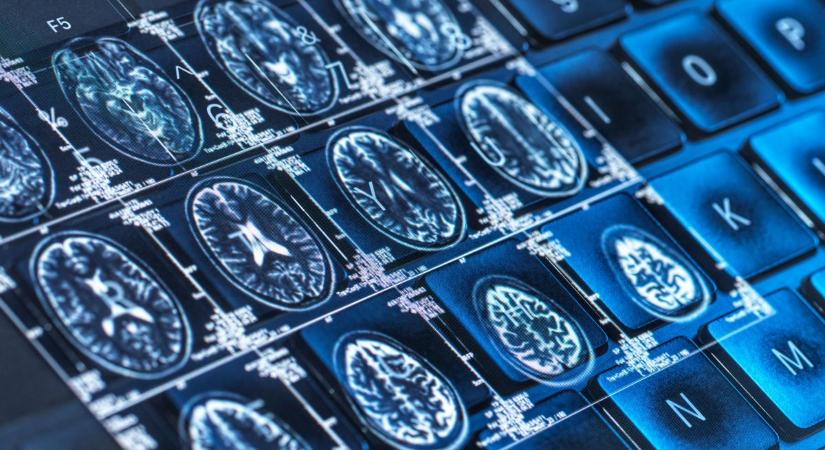 Áttörések az Alzheimer-kór elleni harcban: új remény a világszerte milliókat érintő betegség kezelésében