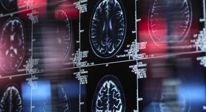 Segíthet a cukor az agynak, hogy küzdjön az Alzheimer-kór ellen