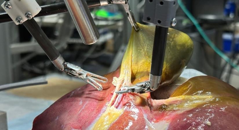 100%-os pontossággal, emberi beavatkozás nélkül műtötte ki az epehólyagot a mesterséges intelligenciával hajtott robotsebész