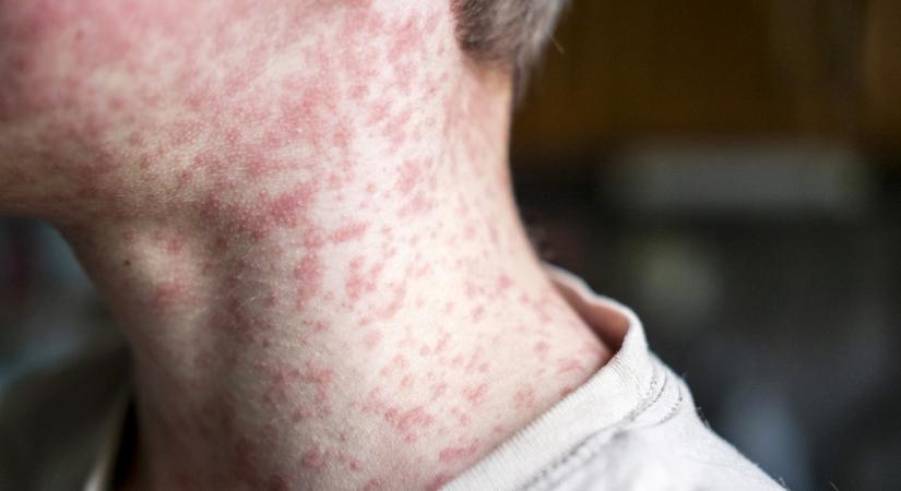 Visszatérőben van egy legyőzöttnek hitt halálos betegség