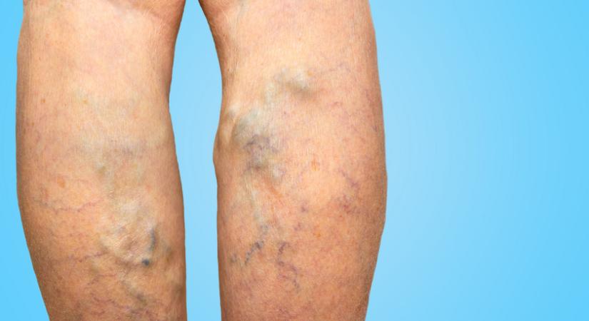 A lábszár viszketése és hámló bőrfelület is jelezheti az elváltozást: a visszérbetegség figyelmeztető tünetei